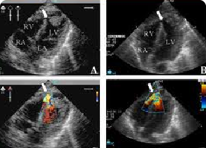 echocardiography